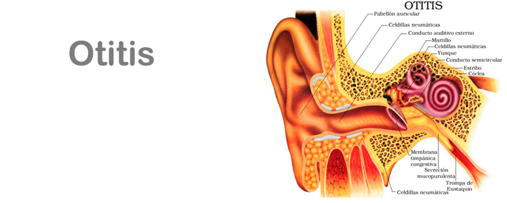 otitis